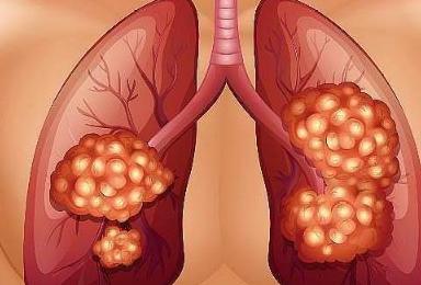 新辅助治疗后肿瘤消失了，手术白做了？答案恰恰相反
 
有些胃癌患者做完新辅助治疗
