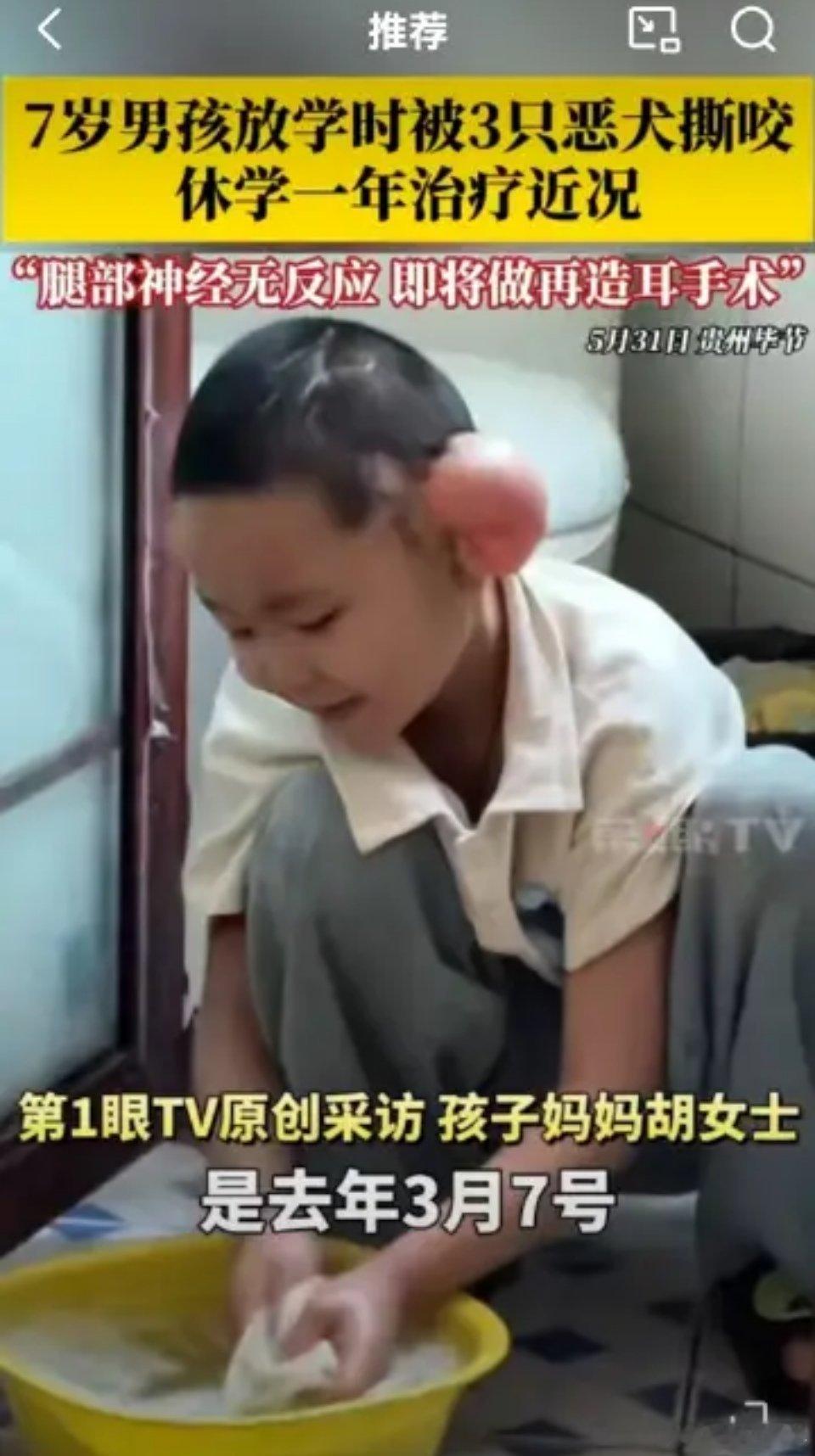 7岁男孩被3只恶犬撕咬一年后近况男孩重伤二级，狗主人涉嫌过失致人重伤罪，已刑拘进