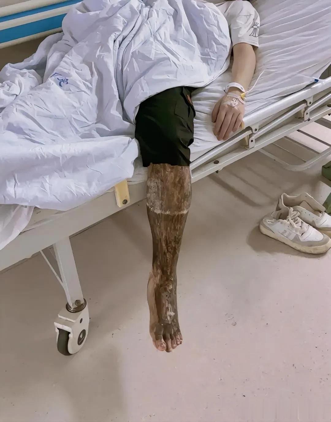 这是被什么虫子咬了一下，还有得救吗？