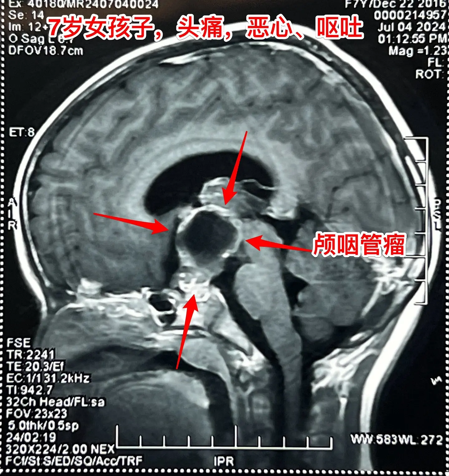 头痛、恶心、呕吐，是颅内高压症状！7岁江西上饶的小女孩，一个月前感头痛...