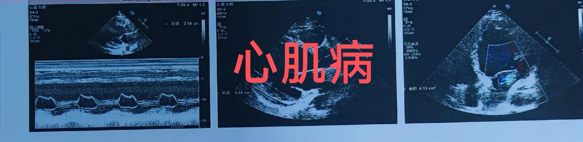 心肌病超声。扩张型心肌病：目前超声仍不能明确诊断扩张型心肌病，只能采用...