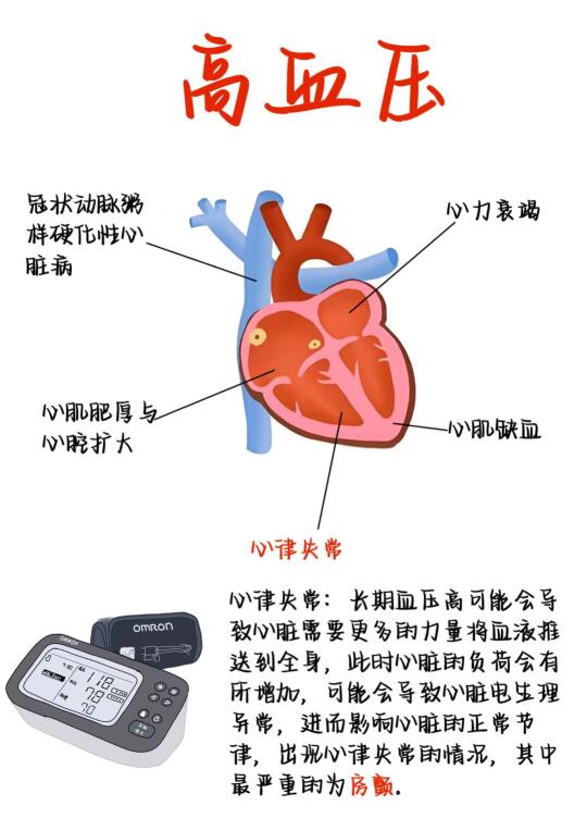 医学生笔记——高血压和房颤的关系