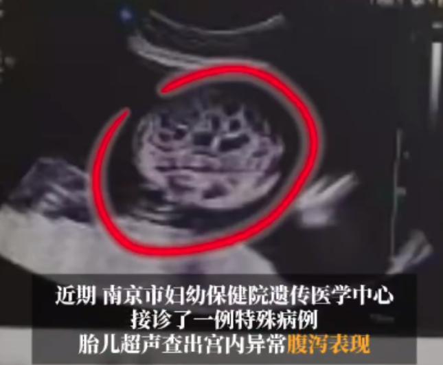 “太离奇了！”江苏南京，29岁孕妈做24周产检，B超探头刚放上去医生就眉头紧锁：