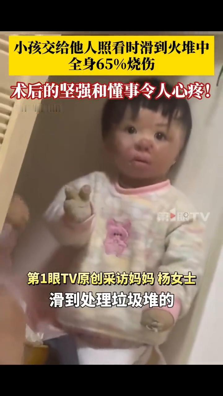 小孩交给他人照看时滑到火堆中，全身65%烧伤，术后的坚强和懂事令人心疼！
第1眼