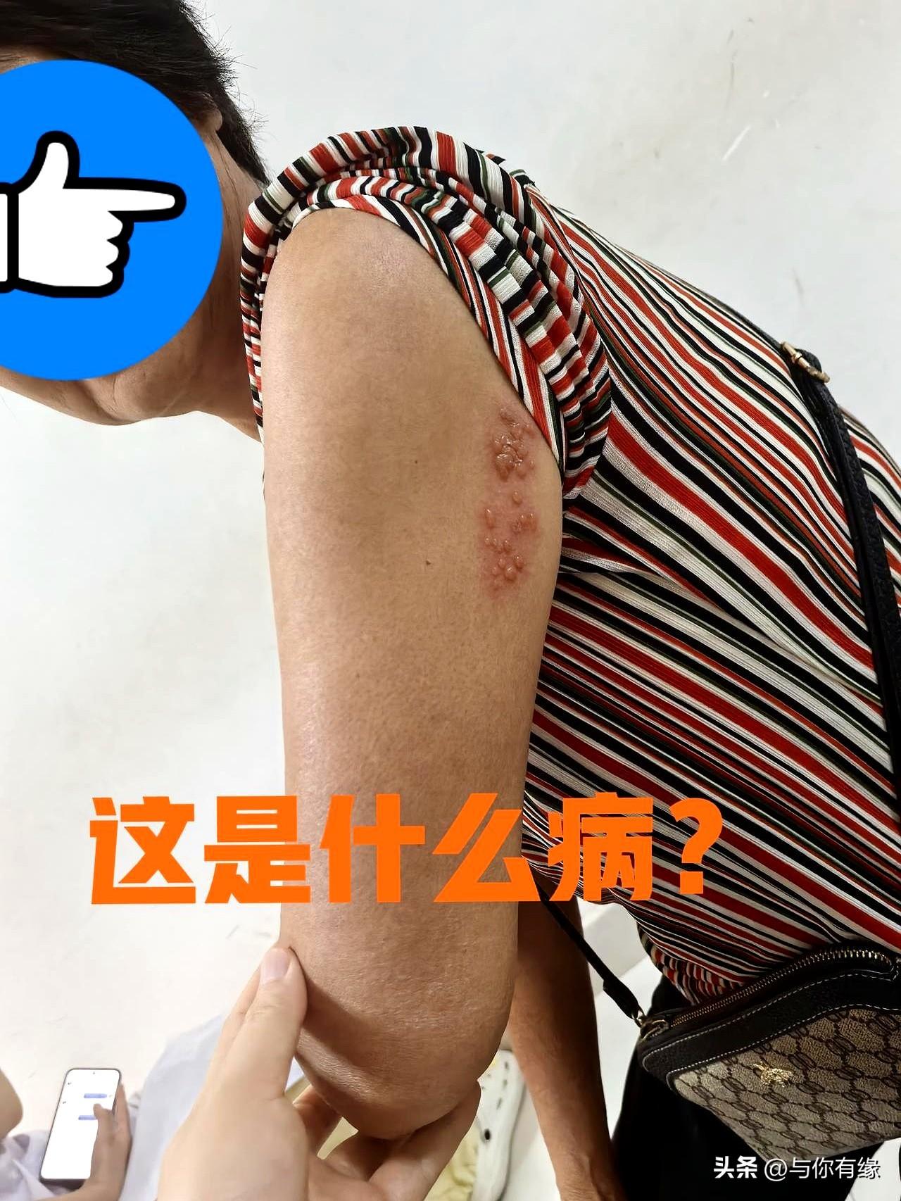 大夏天胳膊长水疱，以为是捂出的痱子？千万别瞎抹粉，小心疼得怀疑人生！
今天门诊来
