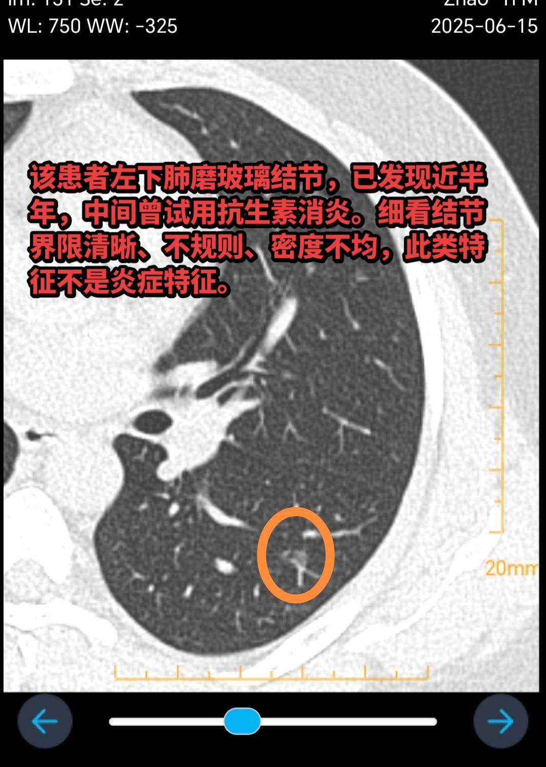 这类磨玻璃结节一般多是肿瘤性的。该患者左下肺磨玻璃结节，已发现近半年...