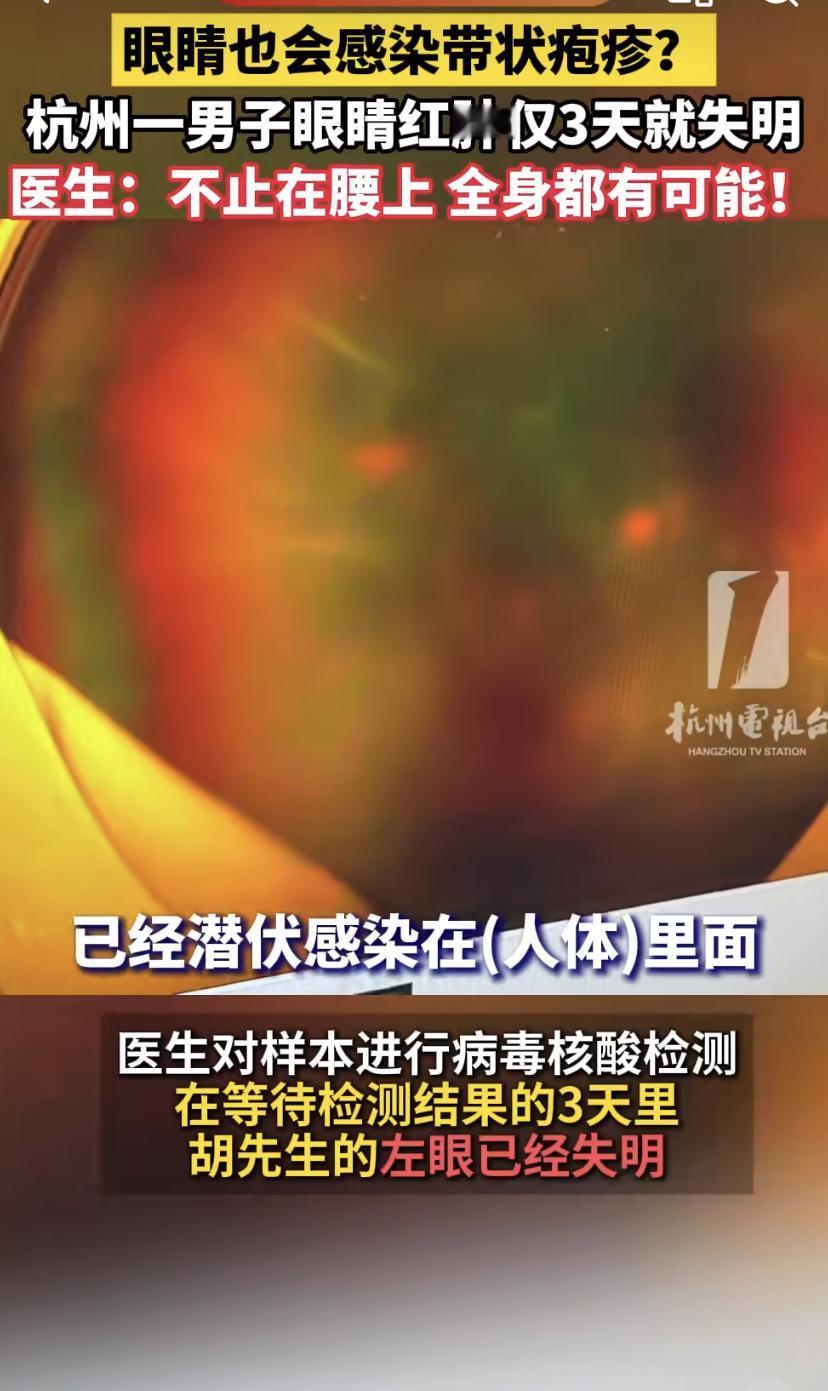 杭州的胡先生怎么也没想到，一次看似普通的眼睛发红，竟会让他在几天内永远失去了左眼