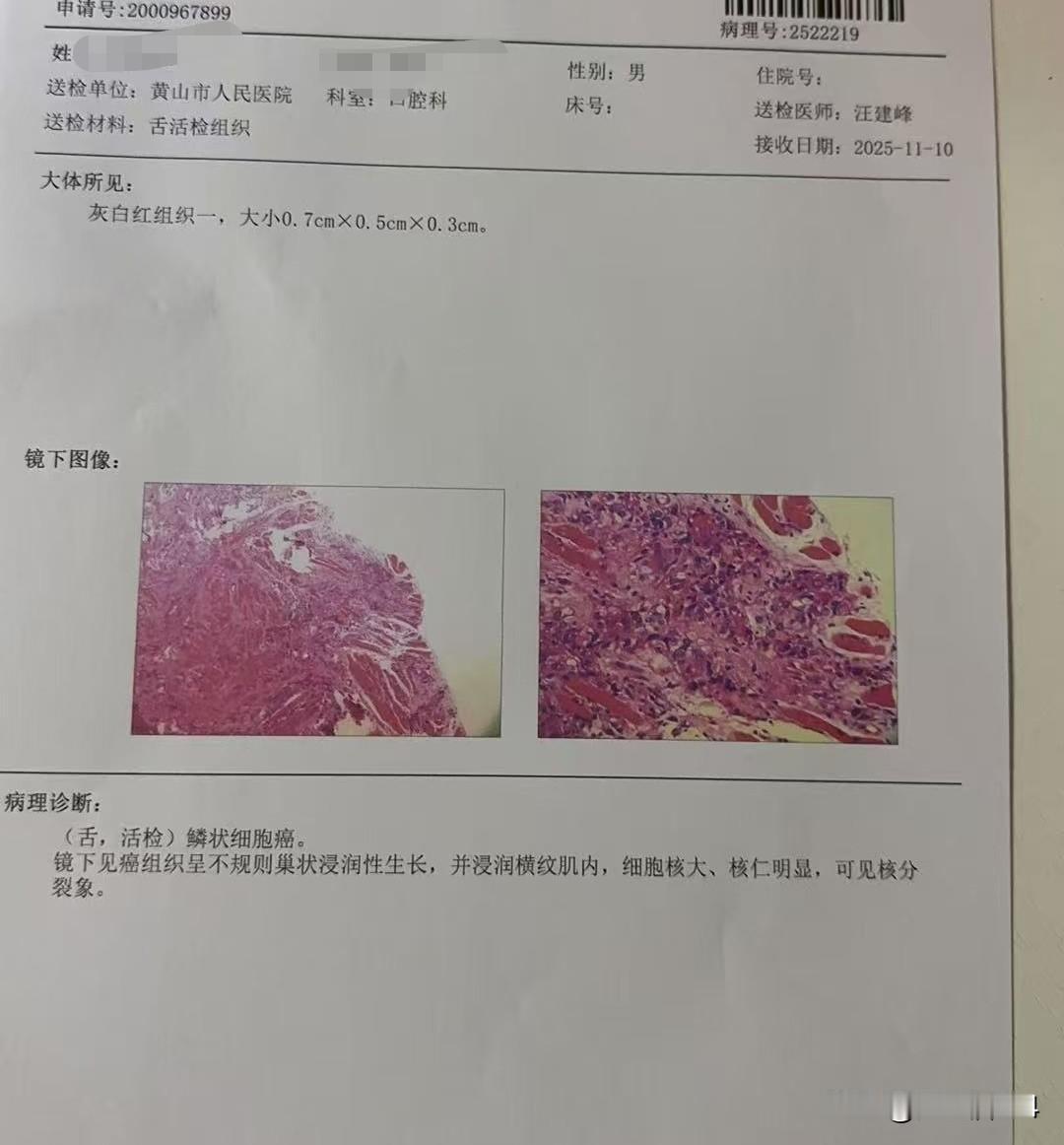 大哥患上口腔癌，刚做了手术，不知道有没有转移…
       六月份开始，大哥吃