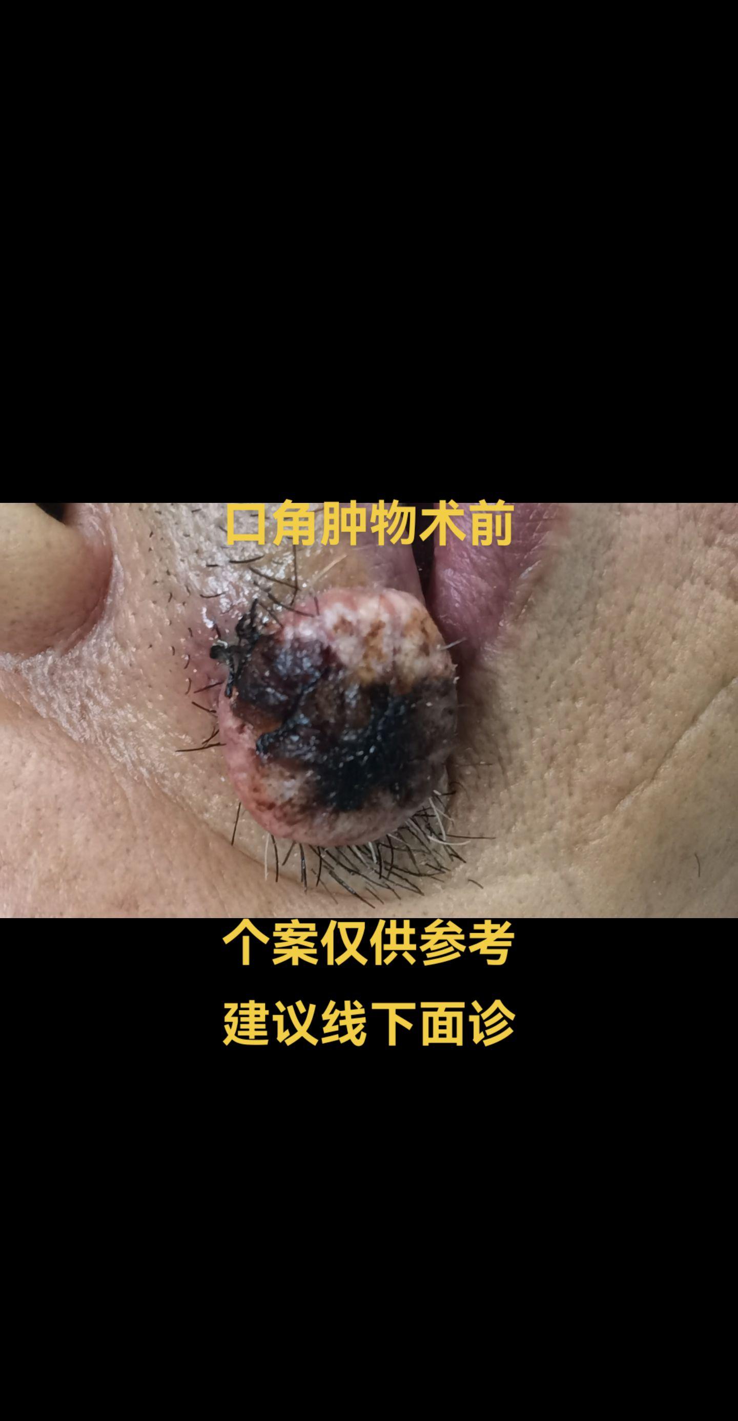 面部肿物。面部肿物术前术后。
医美