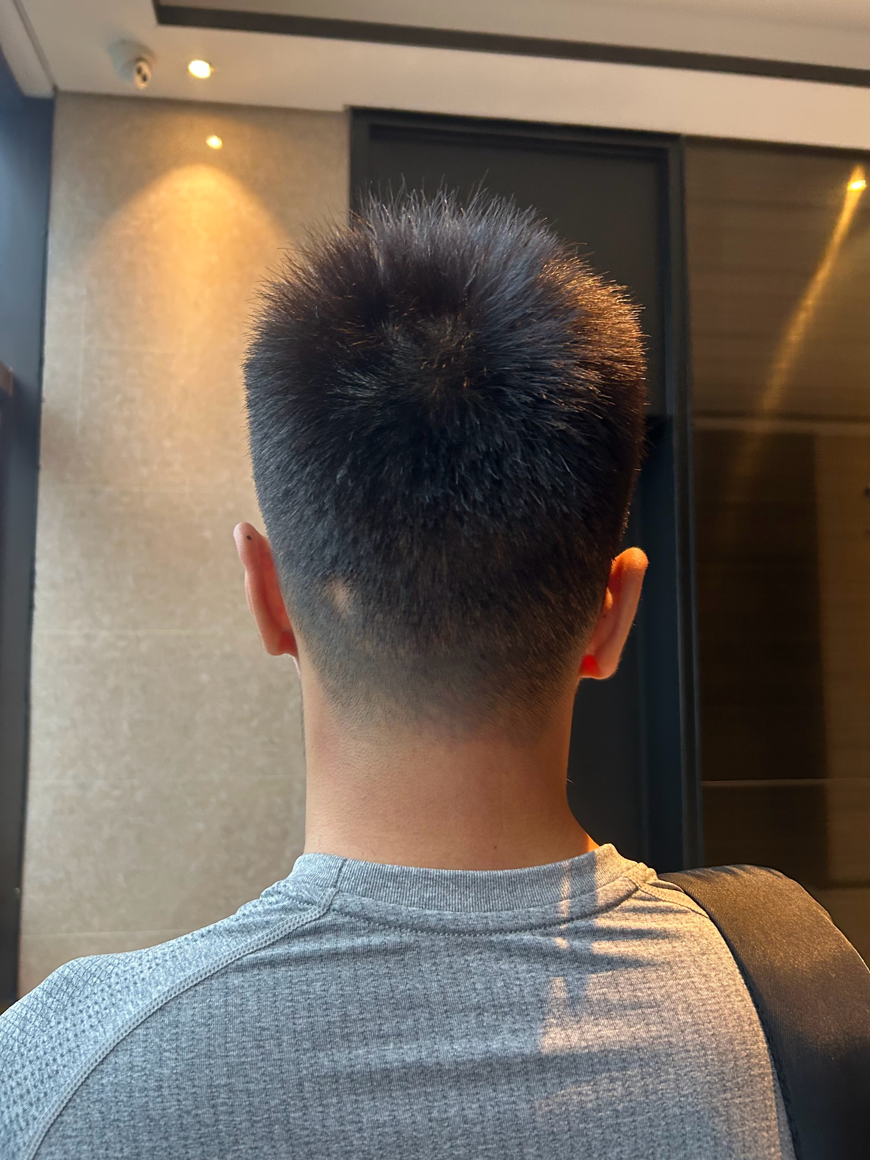 从植发取发的时候医生跟我说我这个地方有个疤开始我就感觉不对，后面感觉越来越大，结