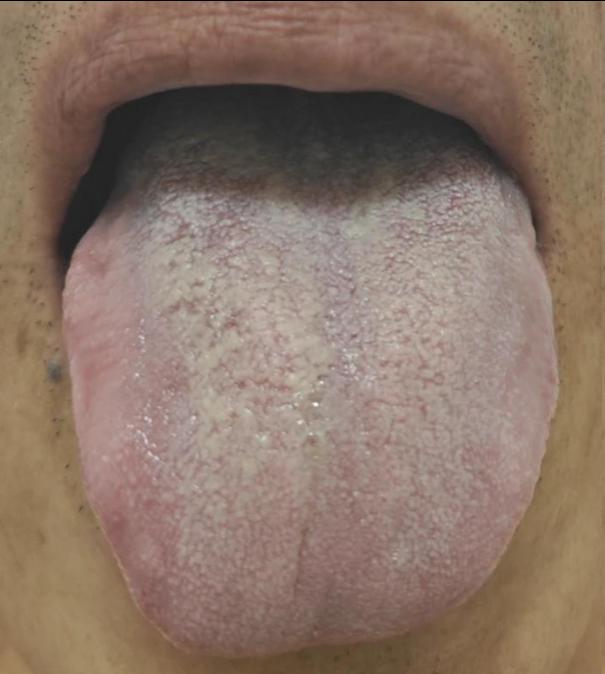 舌胖大 + 厚腻苔？痰湿把脾胃糊住了！消化差、身体沉全因它
大家好，我是中医陈大