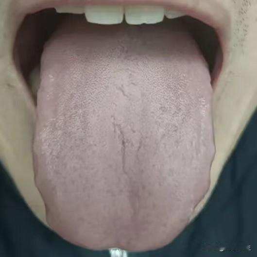 今日舌诊分析：脾虚气血不足 心肺气虚
1、“舌色暗淡，发白”——气血不足，气虚不