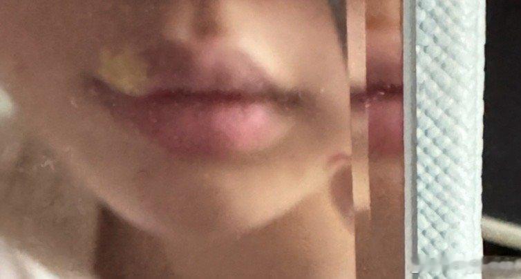 每年冬天都会长疱疹 我已经崩溃了 