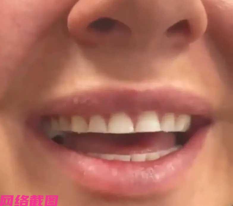 有女子不知怎么突然觉得自己的牙齿长短不齐，这不想到把自己的牙齿找来工具给磨平了。