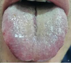 这种情况，千万别再瞎补了！又虚又堵，越补越坏！
病人主诉：瞌睡多、没精神；食欲不