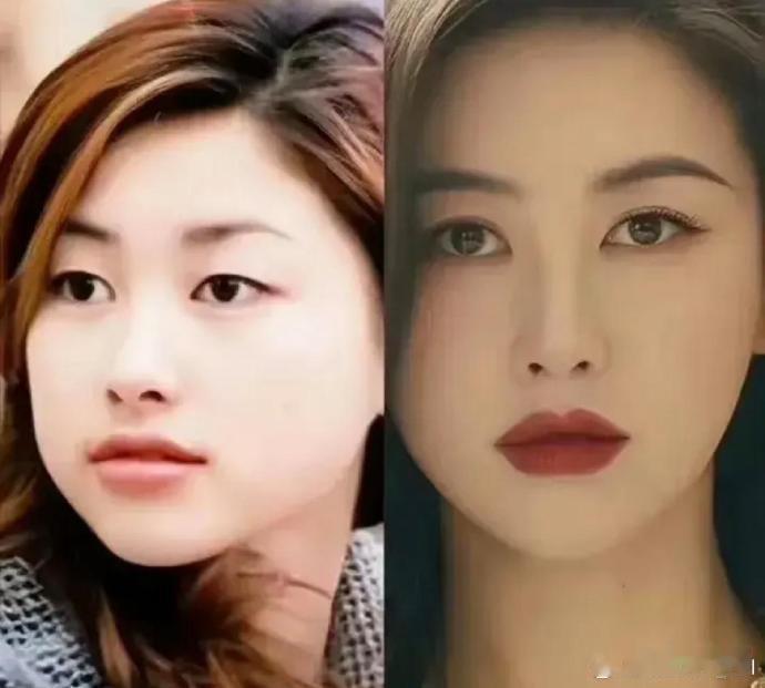 医美效果显著，双眼皮和点痣后，颜值提升，气质也焕然一新。 