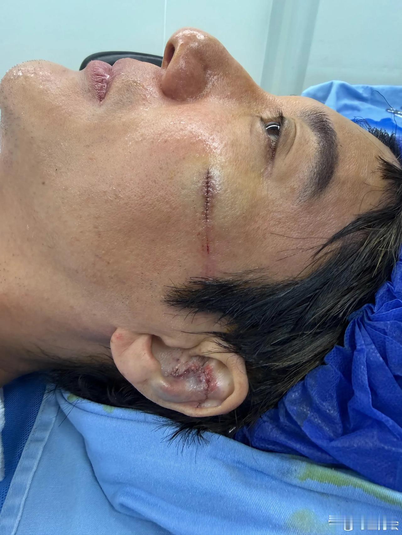 王力宏半夜发文透露摔倒详情，受伤严重，却没有任何埋怨，甚至生气，反而替工作人员说