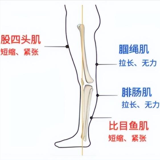 偏瘫后膝过伸，走路姿势难看想改善？先搞明白这三个原因

很多偏瘫患者在走路时，会