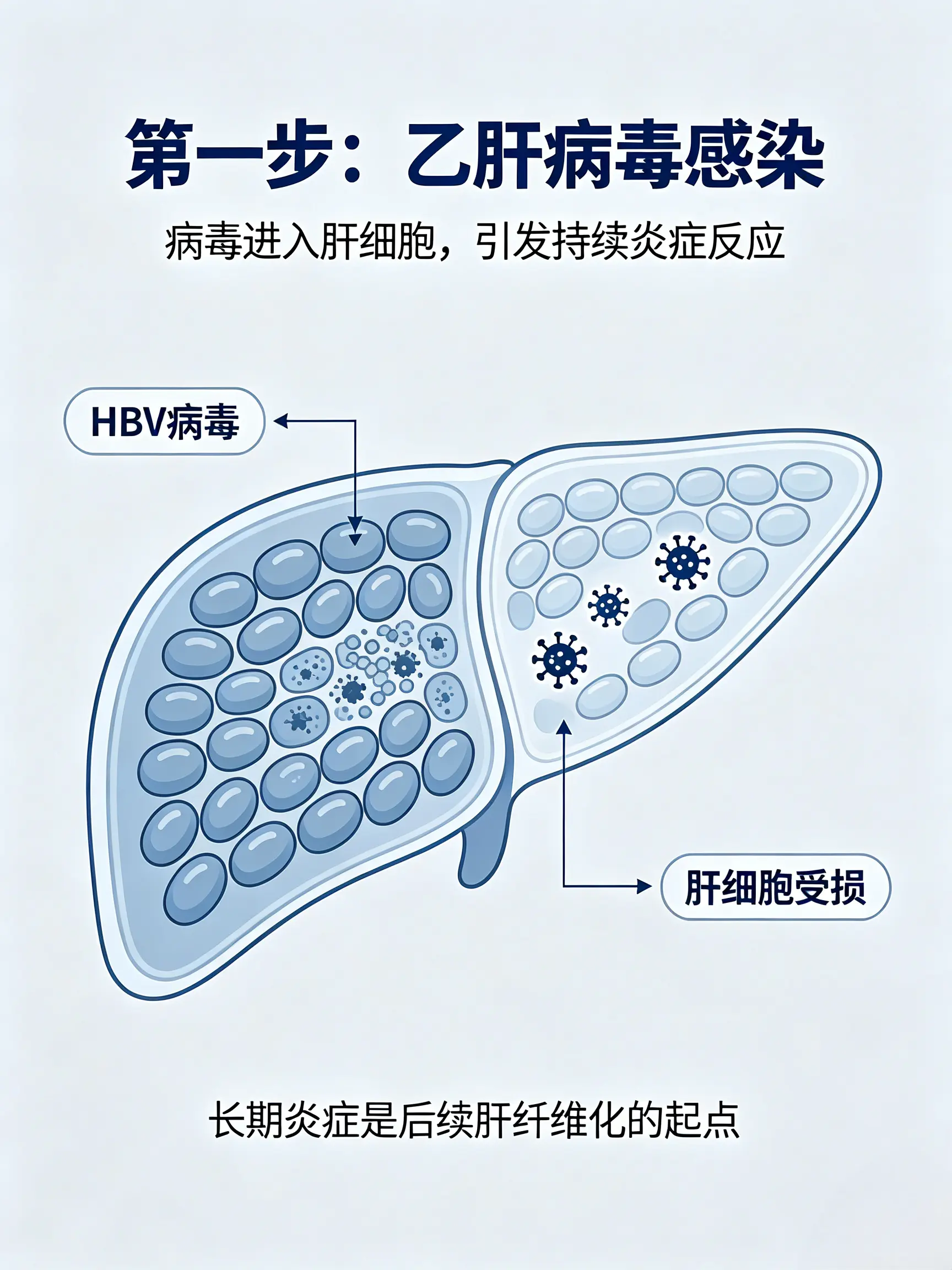 从乙肝—肝硬化—肝癌，你的肝脏究竟经历了什么