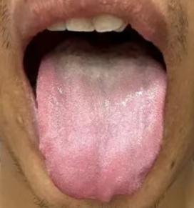 看这个舌头，很典型！脾肾阳虚+痰湿，时间几乎以秒来算，但是千万不要补阳！
患者主