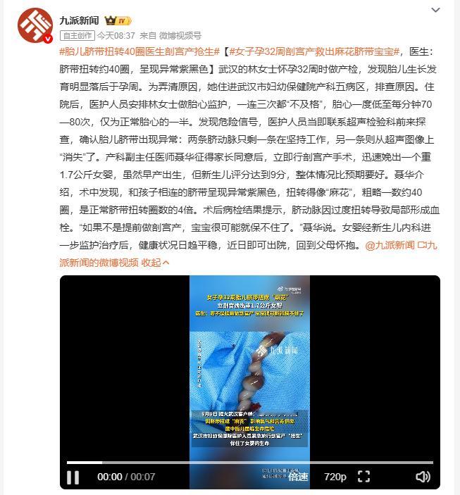 女子孕32周剖宫产救出麻花脐带宝宝怀孕32周的林女士胎心监护多次不及格，医生排查