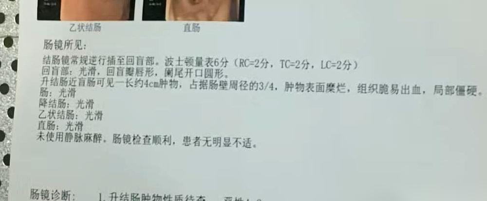 那张报告单，轻飘飘的，拿在手里却有千斤重。
​
肠癌，中晚期。
​
脑子里嗡的一