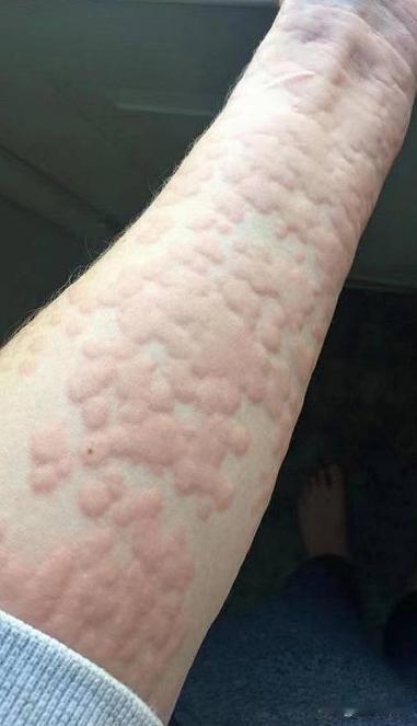 荨麻疹越挠越痒 怎么破？ 
 
“痒痒痒啊，忍不住不挠啊”这是荨麻疹患者说得最多