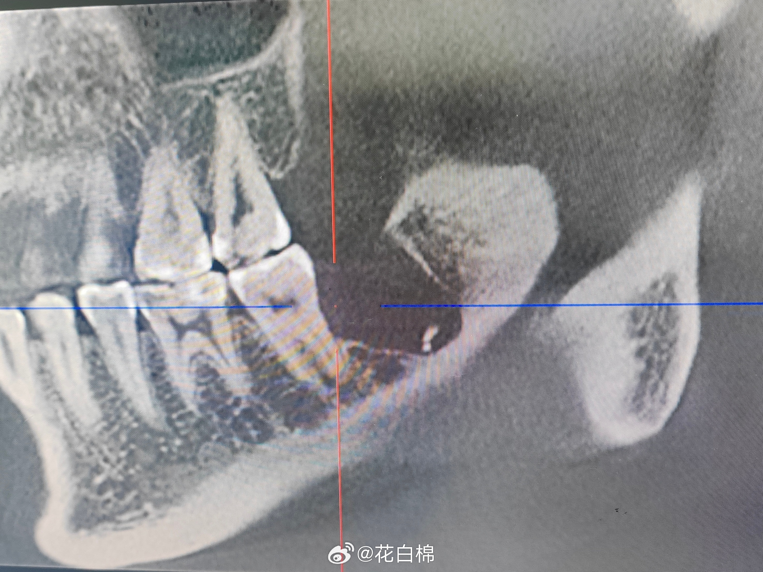 男子拔牙后挂水13天拆线还漏2根这个我有绝对的发言权，上个月拔的深阻生智齿，到现
