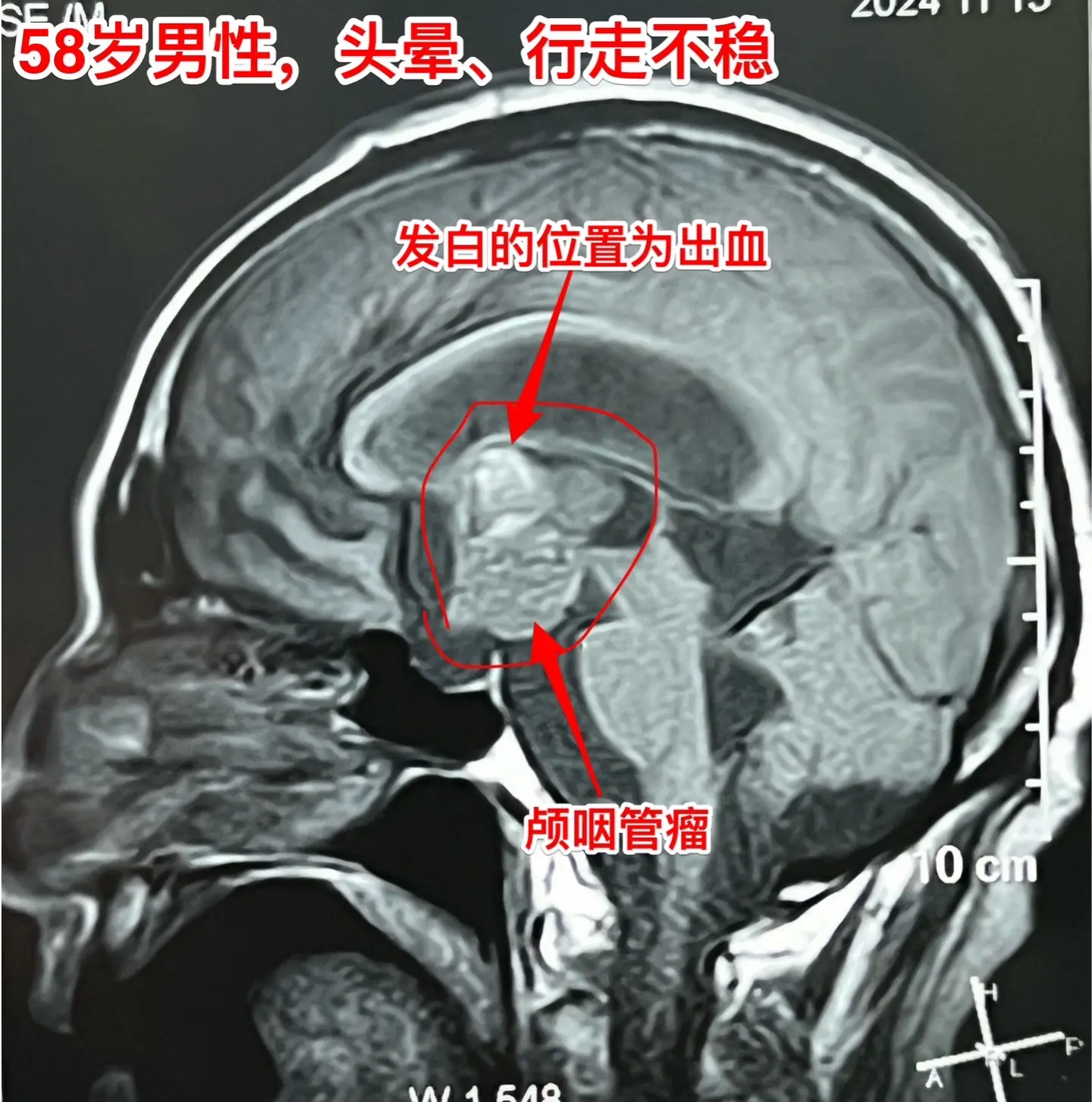颅咽管瘤内出血（瘤卒中）属于罕见现象。有些脑部肿瘤容易出血，称之为瘤卒...
