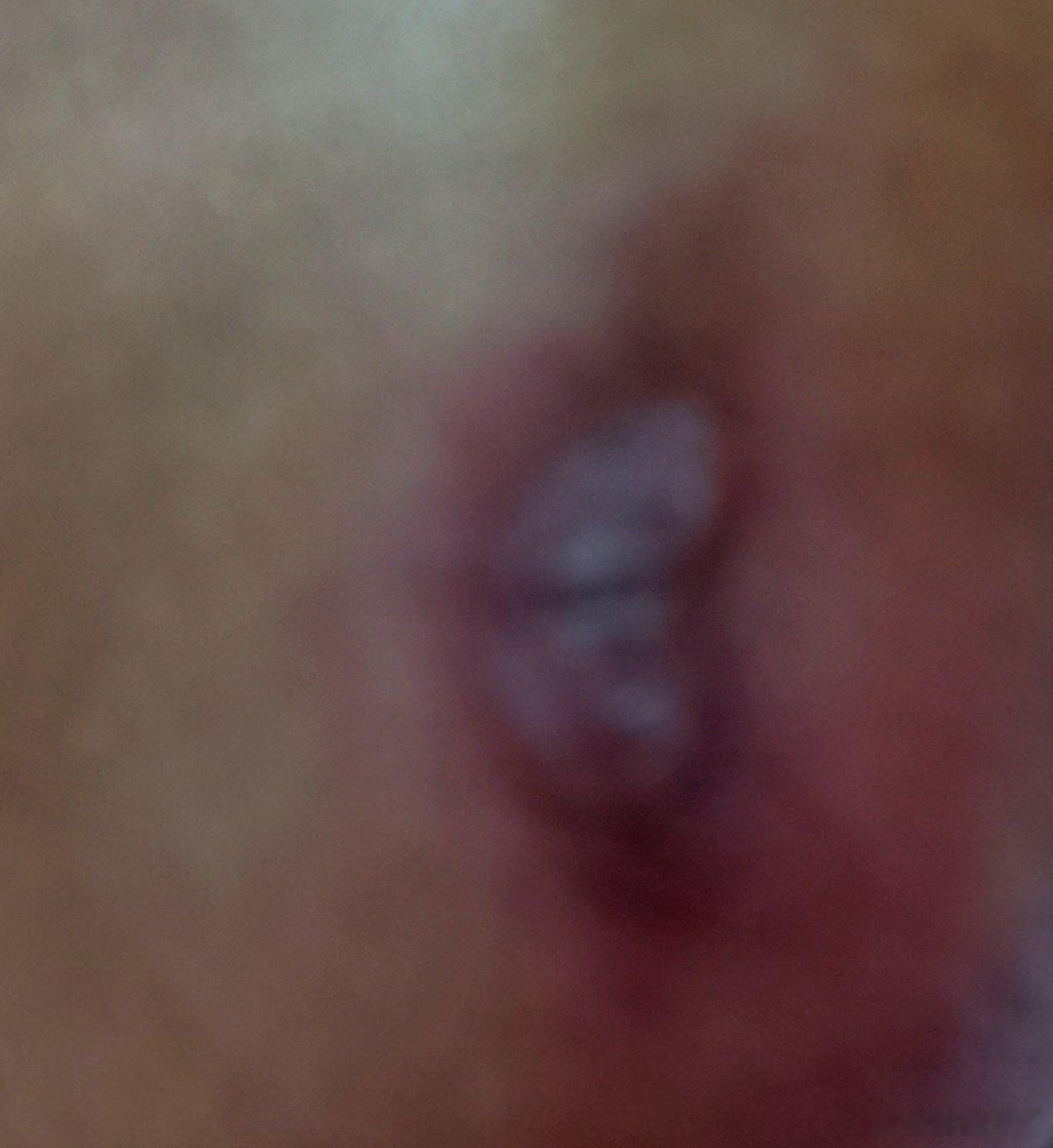 胳膊肘处留疤了，而且是这伤疤超难看！[喵喵] ​​​