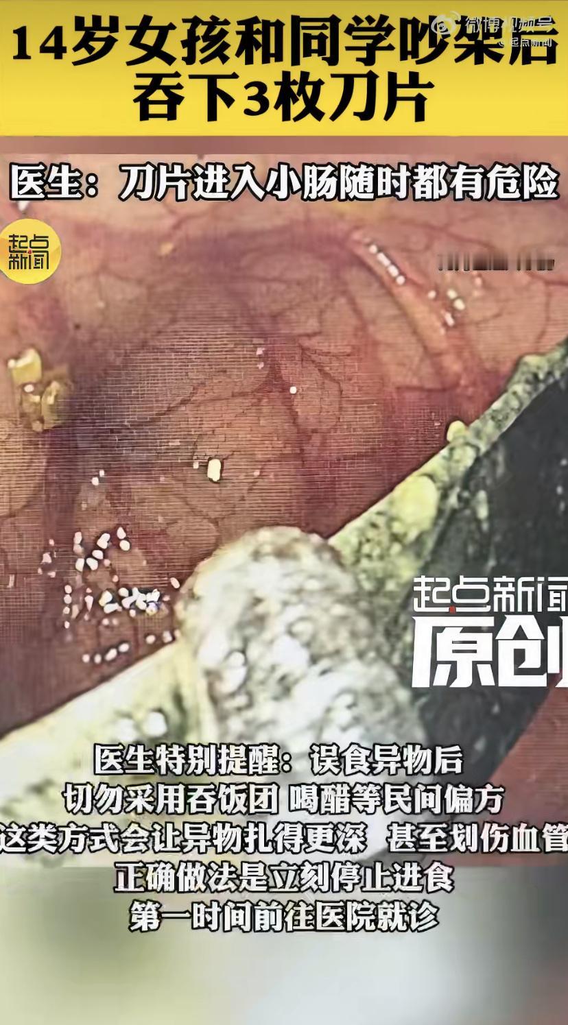 西安一个14岁姑娘小丽，跟同学闹了点别扭，一时想不开，竟然吞了三枚修眉刀片。
家