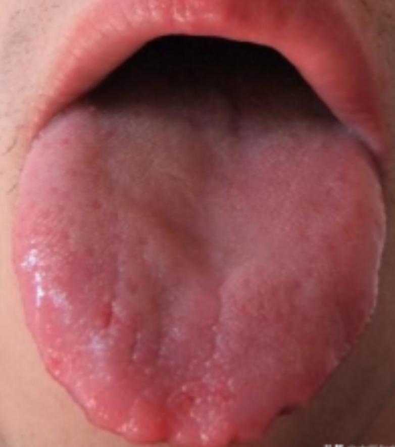 肾阴虚、肾阳虚还在傻傻分不清？中医教你看舌辨阴阳，一次读懂

      如果你