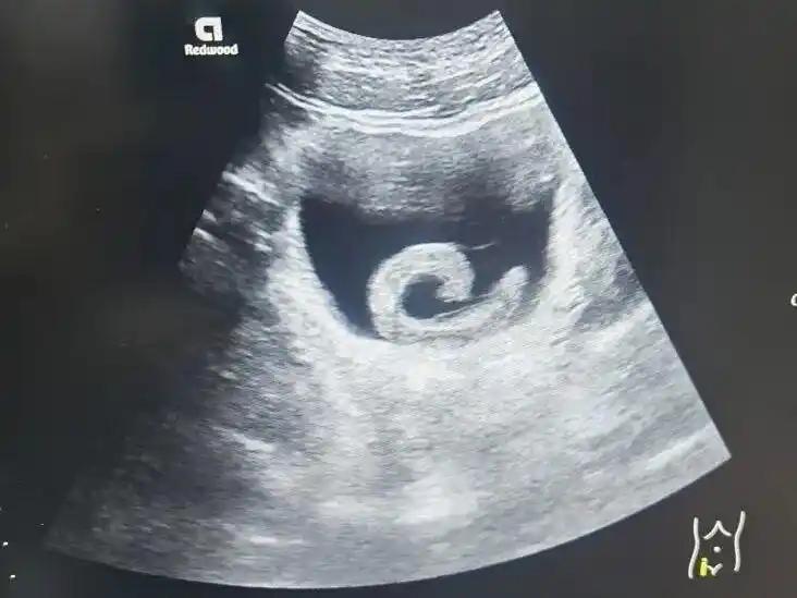 “太荒唐了！”河南一23岁男子轻信离奇偏方，竟将一条5厘米长的活水蛭塞入尿道。不