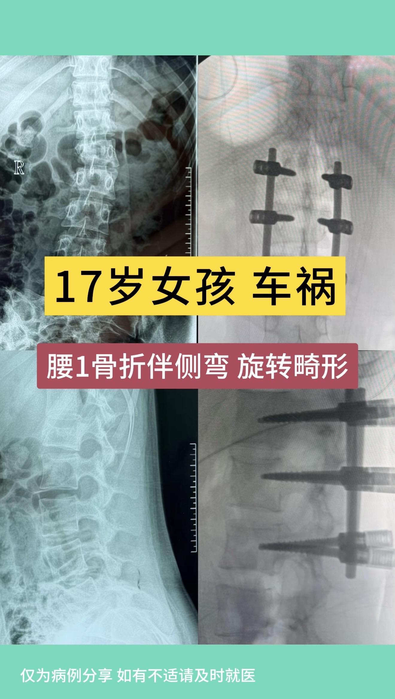 17岁女孩，车祸后腰1骨折伴侧弯，旋转畸形。术后畸形恢复好。