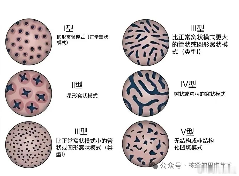 Pit‑Pattern（工藤腺管开口分型）原理：色素放大内镜观察结直肠黏膜隐窝开