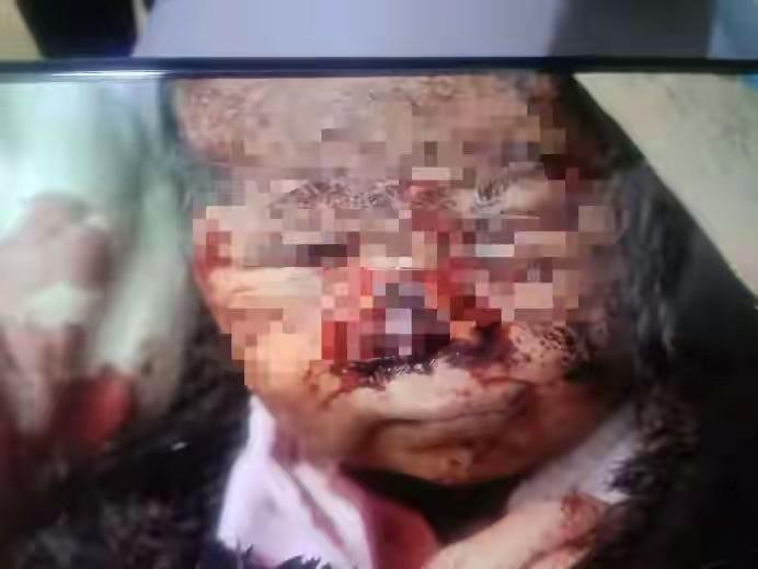 真的破防了！5岁藏族娃出生4天就被黄鼠狼咬坏鼻子和眼睛，家里穷得治不起，差点带着