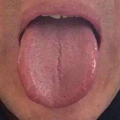 舌中有裂纹可不是小事 千万要注意
从这位患者的舌象来看，确实存在肝郁脾虚、湿热内
