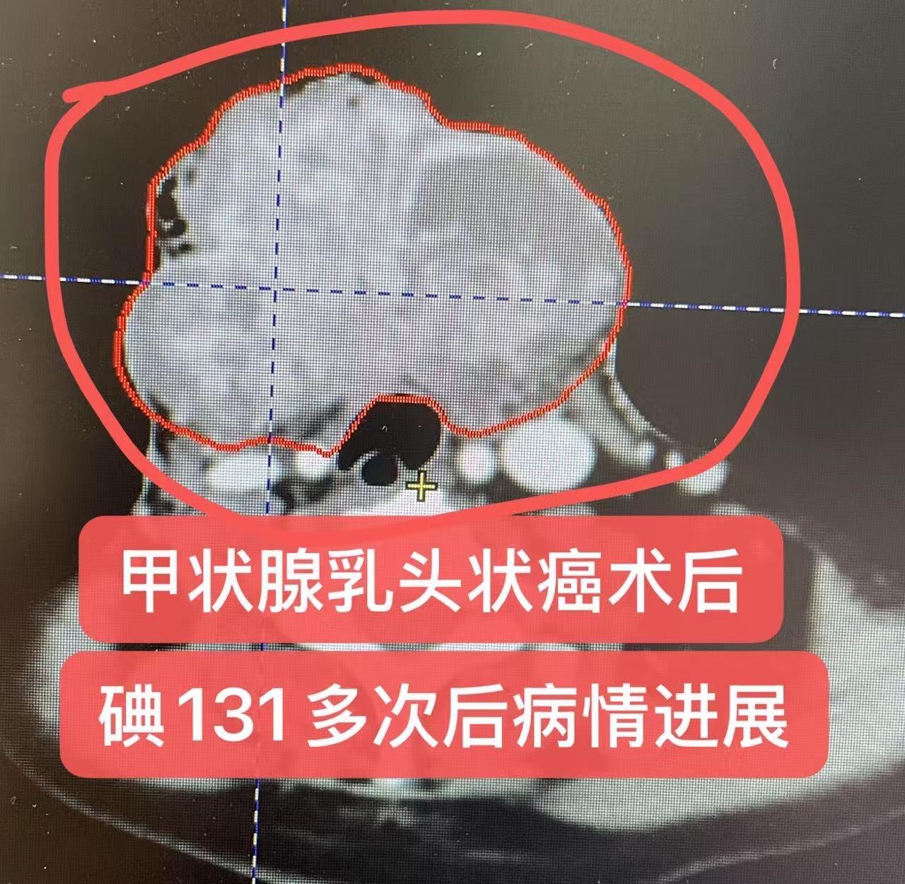 甲状腺乳头状癌术后碘131后复发。术后碘131多次，病情进展，包块较大...