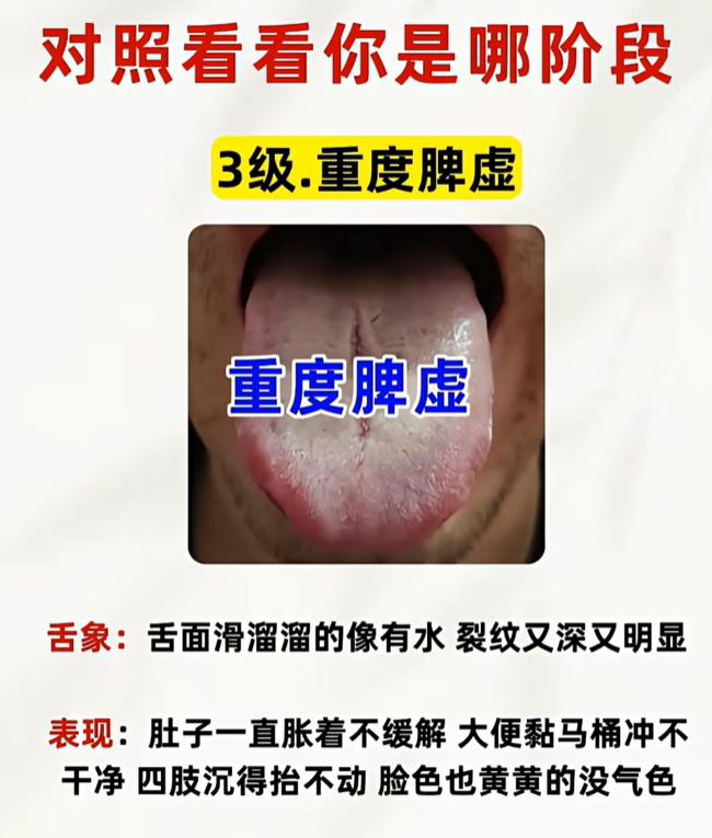 齿痕、裂纹区分四级脾虚，腹胀便溏对照舌头看一看