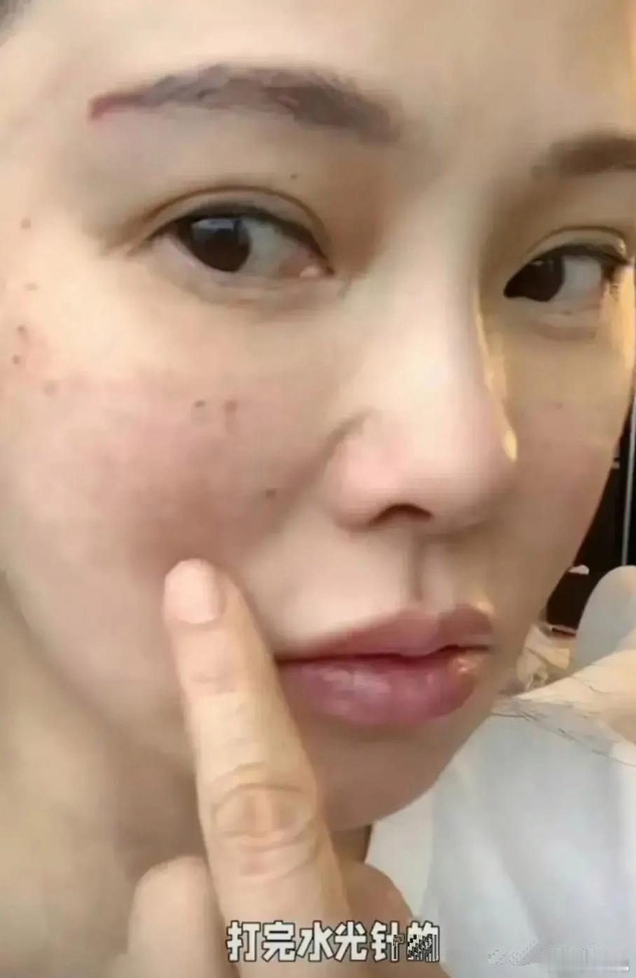 伊能静展示赴韩打水光针的成果～原来她的年轻是打针保养弄出来的呀[允悲] ​​​