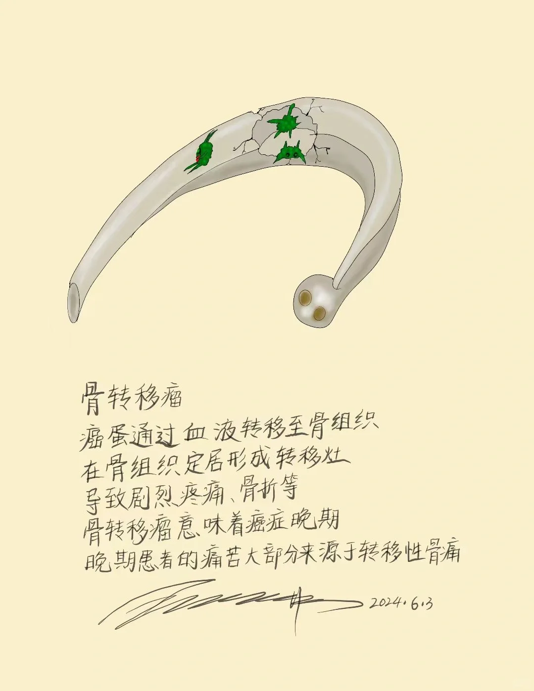 骨转移瘤