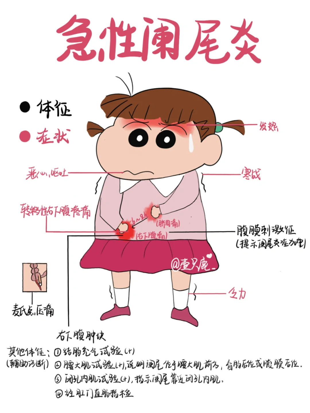 医学生笔记📒｜急性阑尾炎🧐