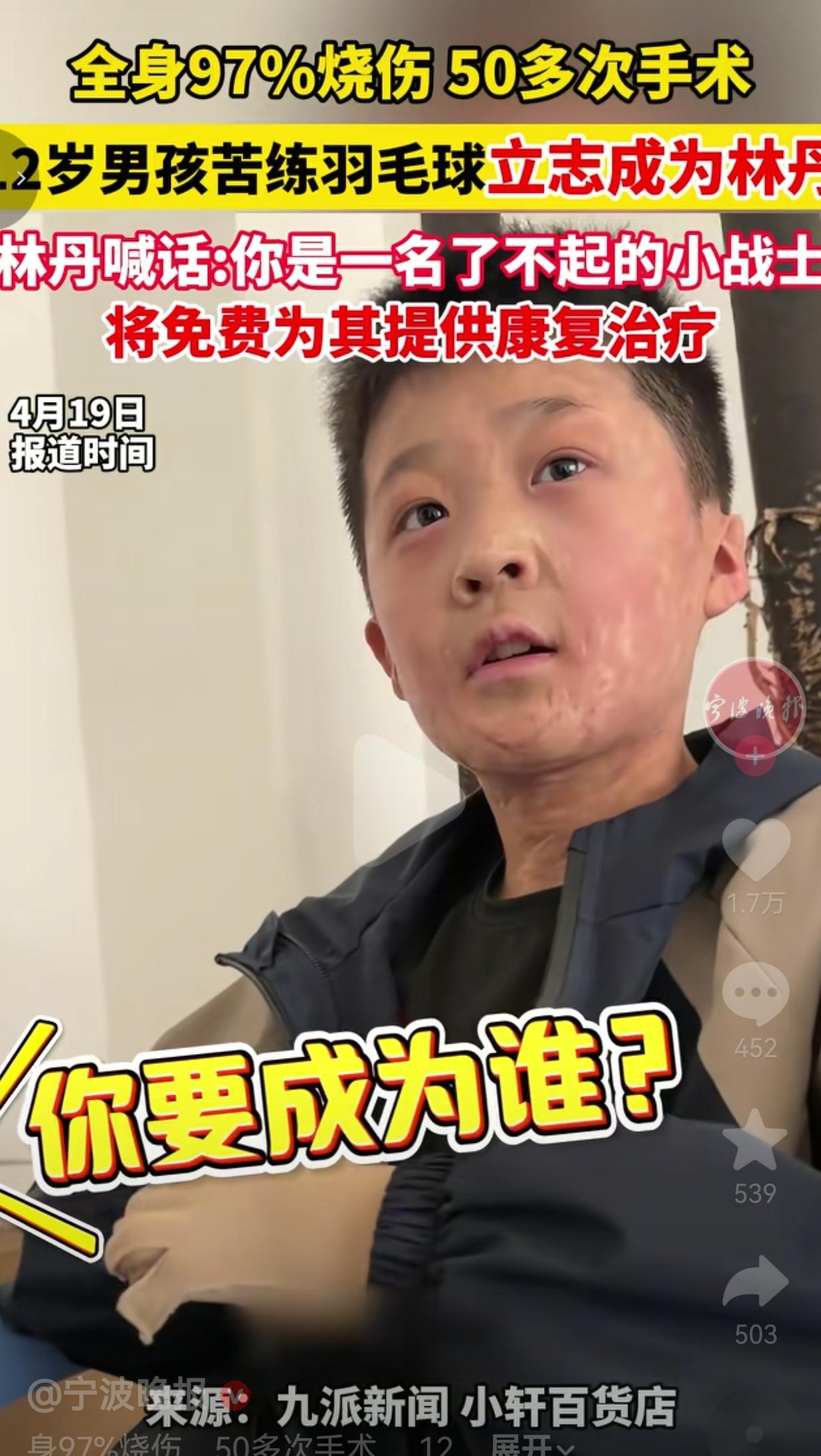 被大火烧了97%的12岁男孩，他说要成为林丹，林丹真的回应了
 
全身97%烧伤