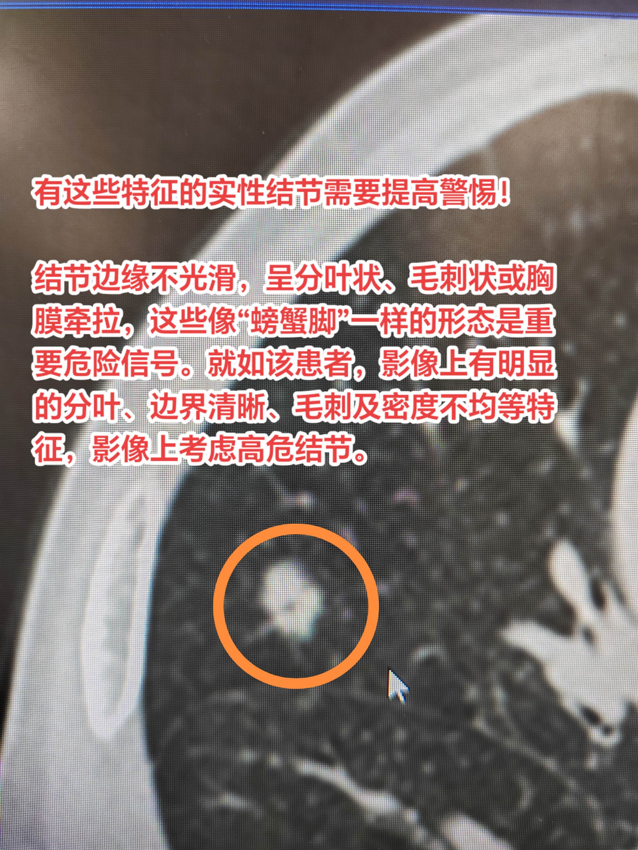 有这些特征的实性结节需要提高警惕！肺结节边缘不光滑，呈分叶状、毛刺状或...