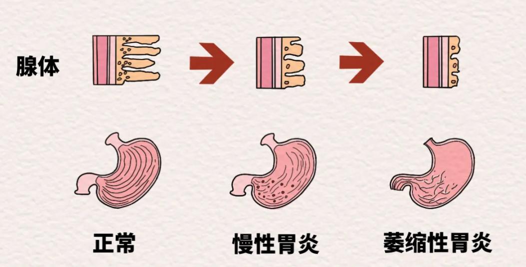 慢性萎缩性胃炎，最常见的表现都有哪些？今天一次性给大家讲清楚。
慢性萎缩性胃炎主