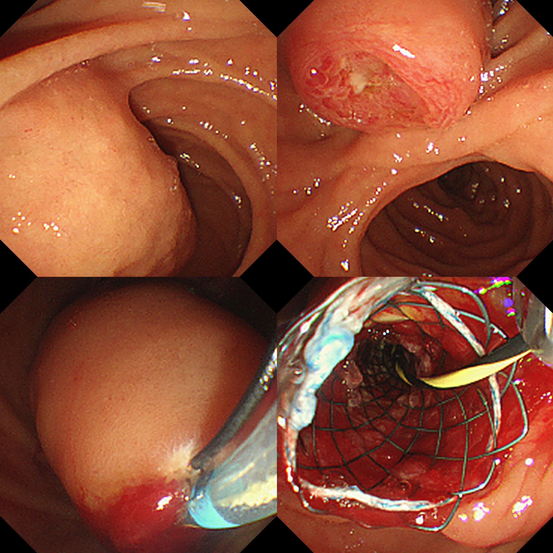 2026年的第一例ERCP，迎战完全梗阻胆管癌。 虽然辐射剂量远超胆管...