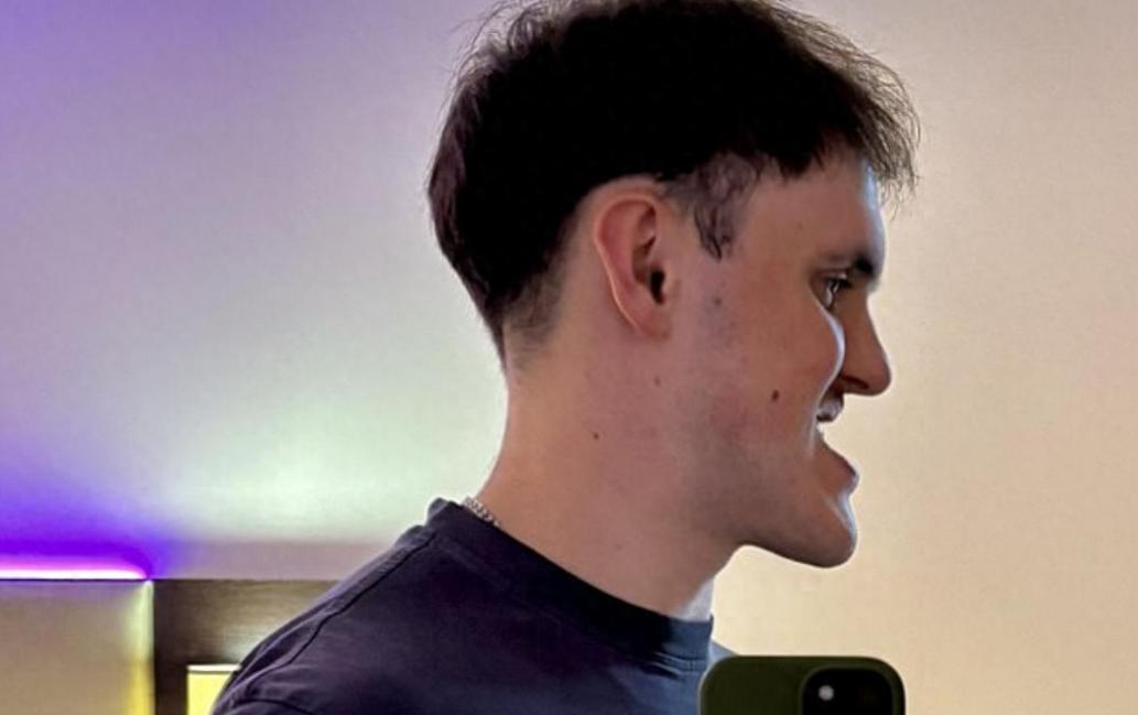 【24岁男子矫正地包天：从自卑到重拾自信的蜕变】24岁来自曼彻斯特的卢克·麦克拉