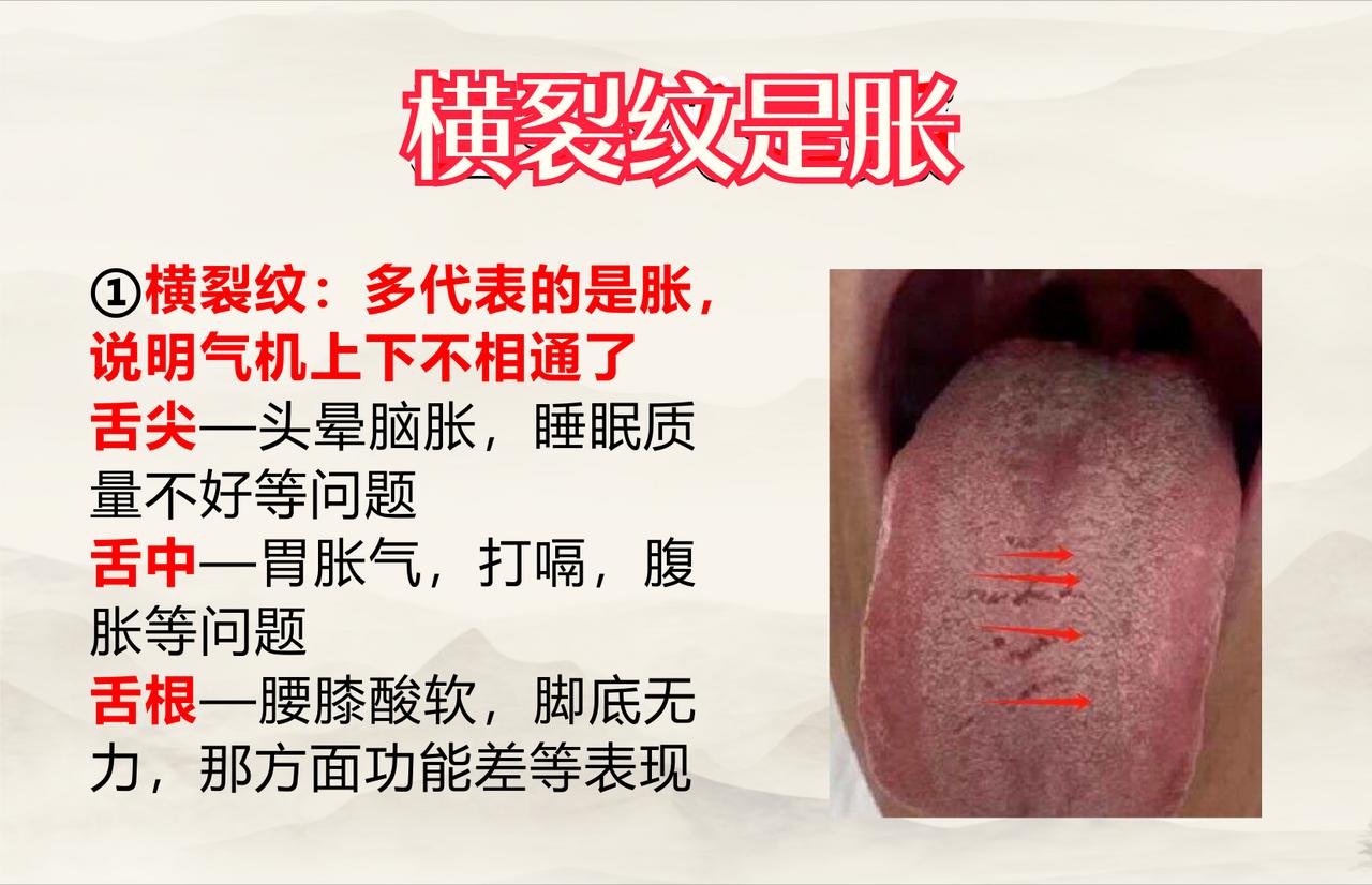 舌头裂纹不同，病就不同！横裂纹“ 胀 ”，竖裂纹“ 痛 ”！

1.横裂纹——胀