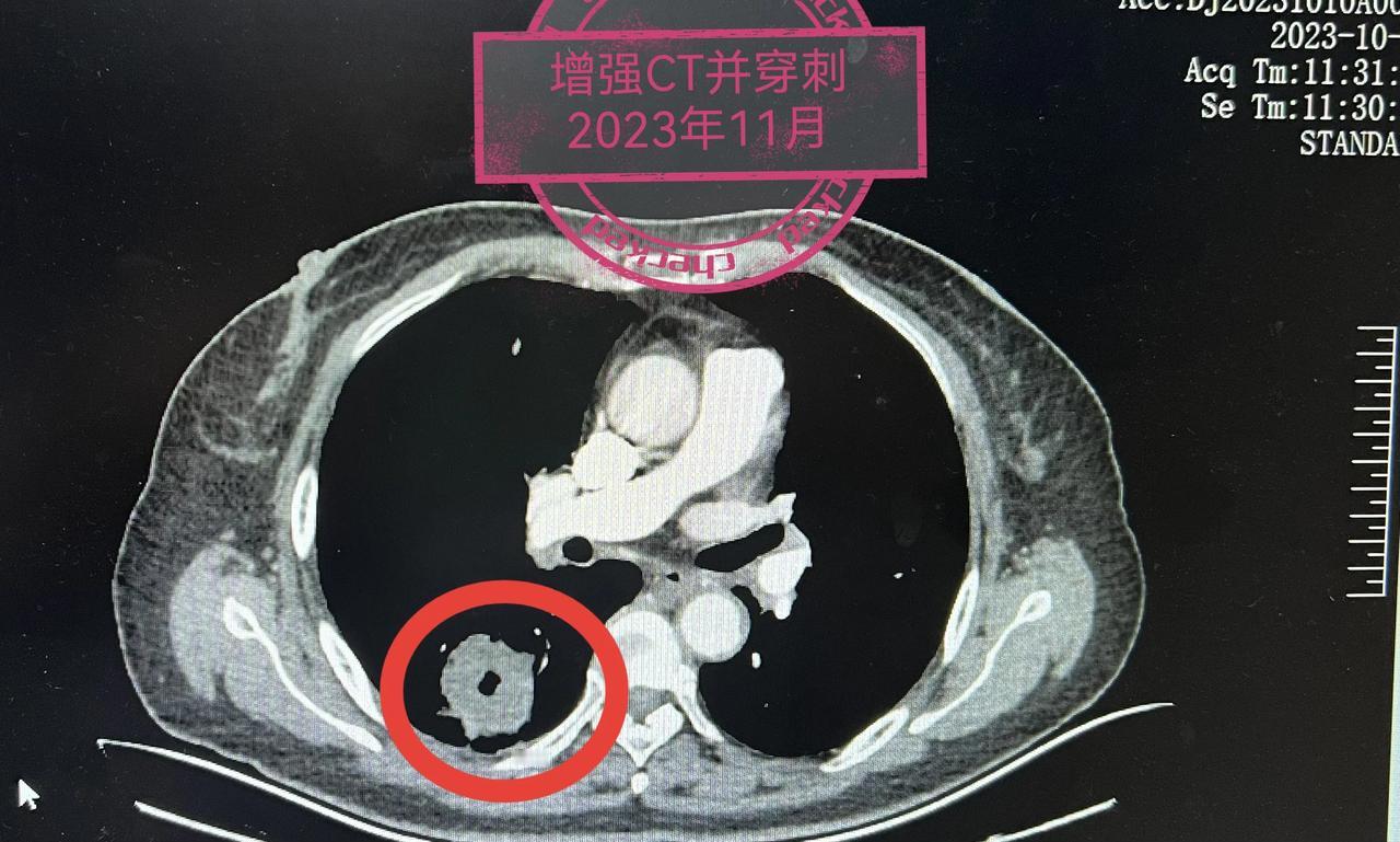 肺结节可能有哪些症状绝大多数肺结节都没有症状，一般都是体检胸部CT发现的。如果结