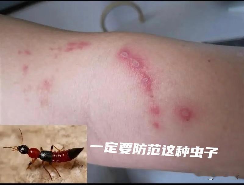 这种虫子怎么这两年越来越多了，家里有孩子的一定要看，隐翅虫进入活跃期。很多人误以